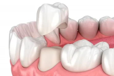 Que faire face à un implant dentaire qui bouge ?