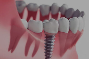 Prix All-on-4 implants dentaires en Tunisie : Tarif tout compris